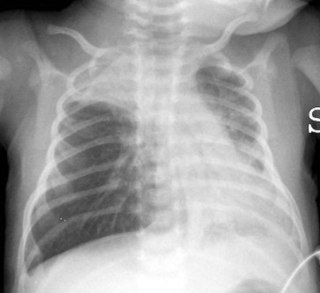 Bronchiolitis chest X-ray.jpg