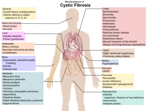 Symptoms of CF Cystic fibrosis manifestations.png