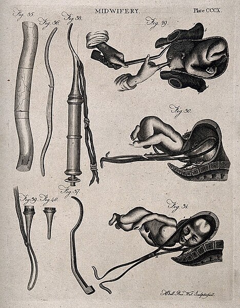 File:Diagram of Instrumental Assisted Birth.jpg