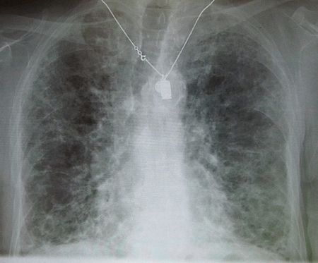 Fibrosis_paru-paru