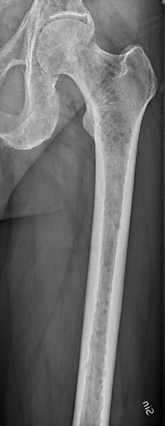 File:Left femur with myeloma.jpg