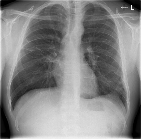 Fail:Lungs with CAP postreatment.jpg