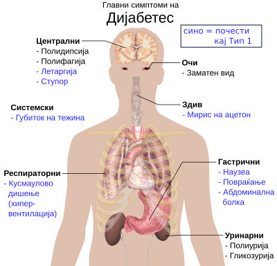 Дијабетес Мелитус Тип 2