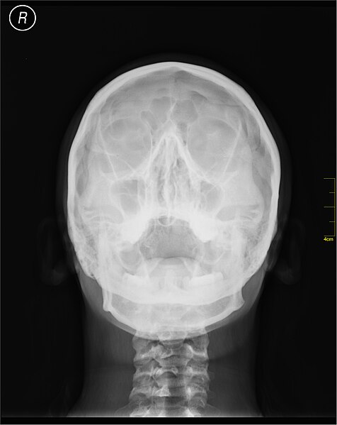 File:Medical X-Ray imaging FBP04 nevit.jpg