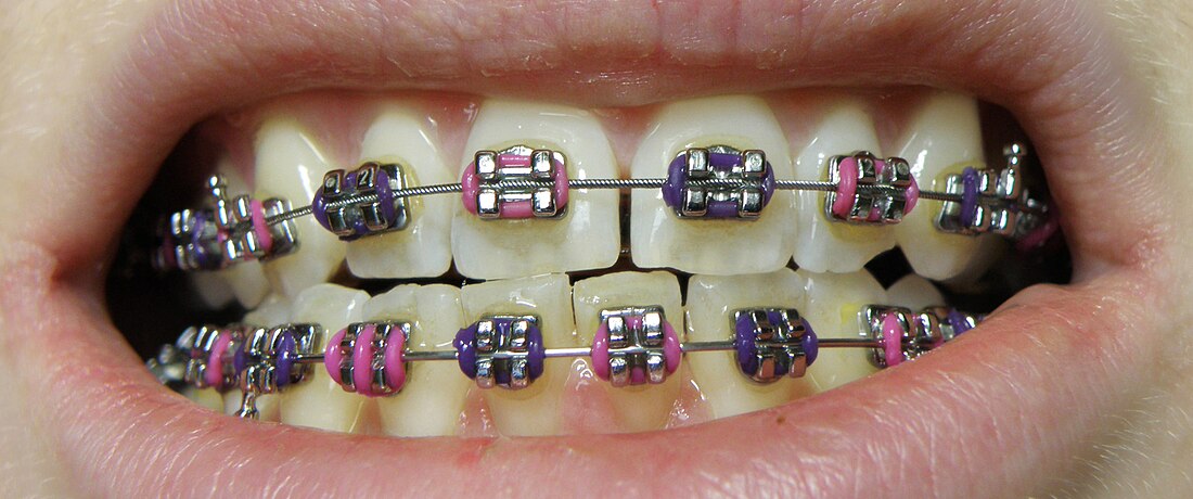 Dental braces