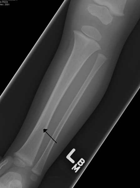 File:Tibfracture.png