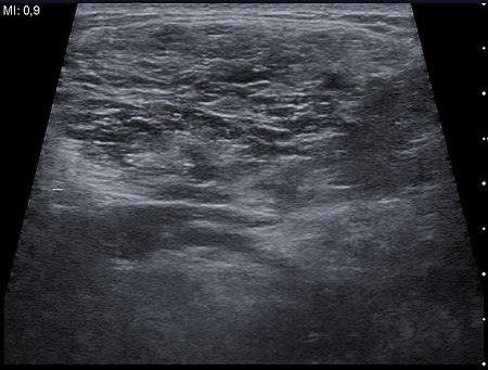 Ultrasound image Cystic Hygroma 20170945718 17F.jpg