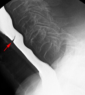 esophageal web barium swallow