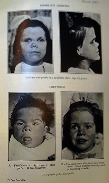 File:'MENTAL DEFICIENCY' (Amentia), FIFTH EDITION, 1929... IMG 3569 edited-23.jpg