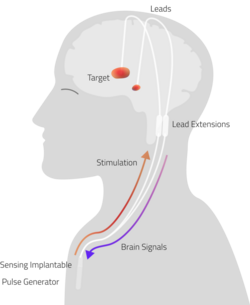 Adaptive Deep Brain Stimulation.png