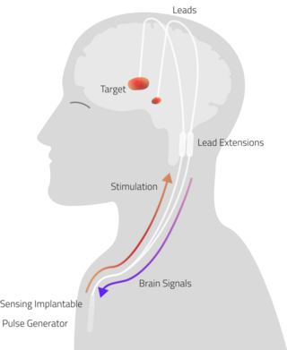 <span class="mw-page-title-main">Adaptive Deep Brain Stimulation</span> Neurosurgical treatment involving implantation of an adaptive neurostimularot