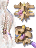 Thumbnail for Facet joint injection