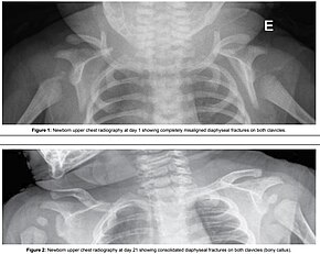 Fracture of both clavicles as a result of shoulder dystocia (top) - Post healing (bottom) ClavicleFractureSD.jpg