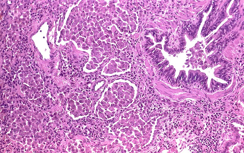 File:Desquamative interstitial pneumonia (7471757634).jpg