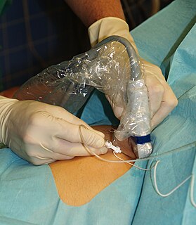 Local anesthetic nerve block