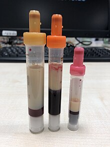 Hypertriglyceridamie.jpg