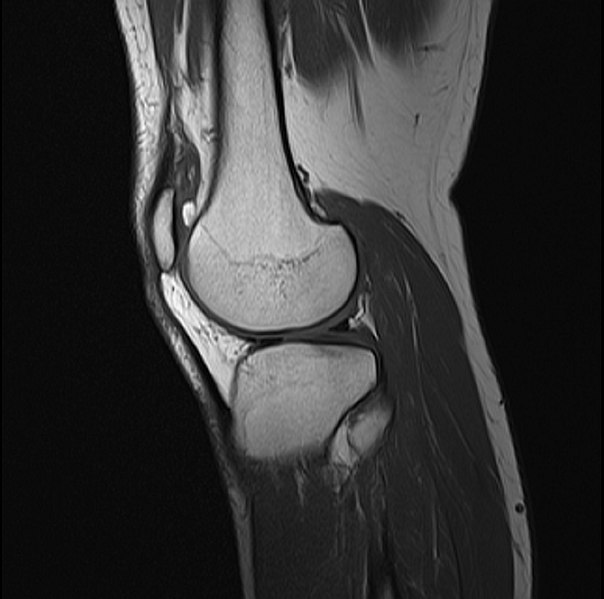 File:Knee MRI T1 TSE Sagittal.jpg