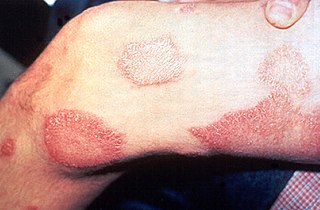 Leprosy thigh demarcated cutaneous lesions.jpg