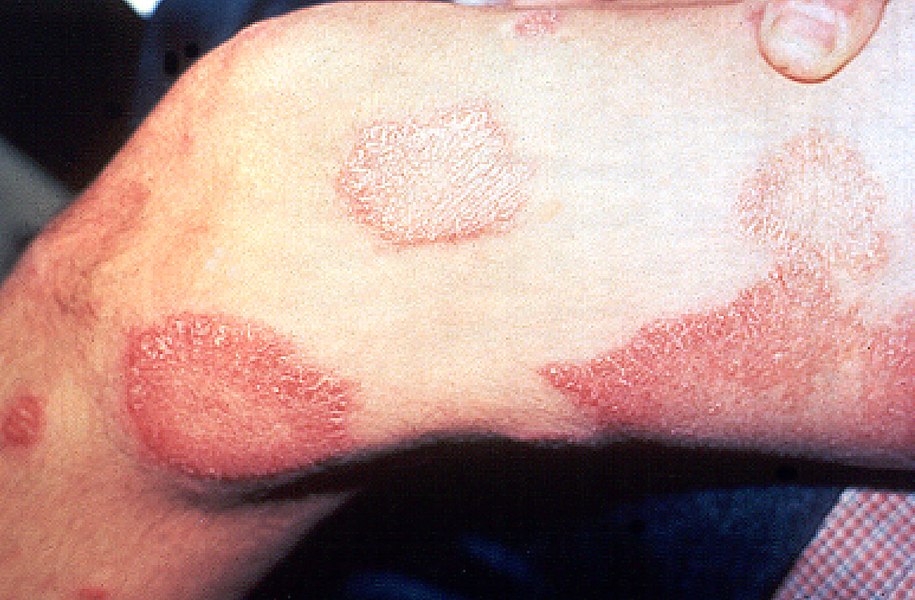 Skin lesions on the thigh of a person with leprosy