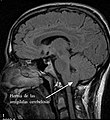 MRI of human brain with type-1 Arnold-Chiari malformation and herniated cerebellum es.jpg