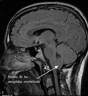 MRI of human brain with type-1 Arnold-Chiari malformation and herniated cerebellum