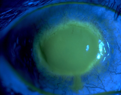 Acanthamoeba keratitis