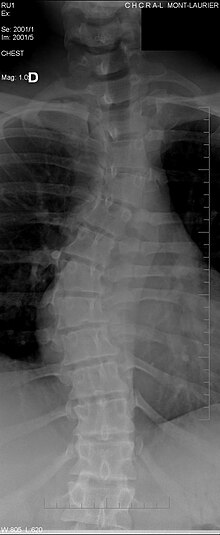 Scoliosis X-ray.jpg