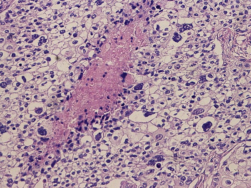 File:SkinTumors-P7100444.JPG