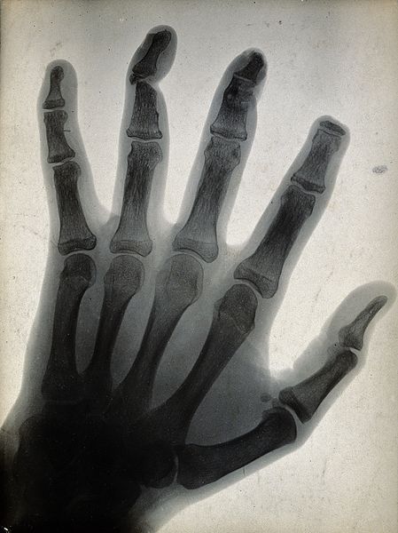 File:The bones of a hand, with the tip of the index finger missin Wellcome V0029542.jpg