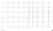 An electrocardiogram of an 18-year-old male showing 'U' waves, most evident in lead V3. U-wave sinus arythmia.jpg