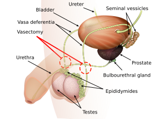 Vasectomy Surgical procedure for male sterilization