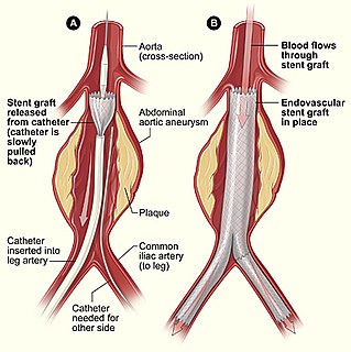 Endovascular aneurysm repair surgery used to treat abdominal aortic aneurysm