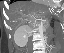 CT scan performed for evaluation of a potential donor. The image shows an unusual variation of hepatic artery. The left hepatic artery supplies not only left lobe but also segment 8. The anatomy makes right lobe donation impossible. Even used as left lobe or lateral segment donation, it would be very technically challenging in anastomosing the small arteries. CT scan showing liver and kidney.jpg