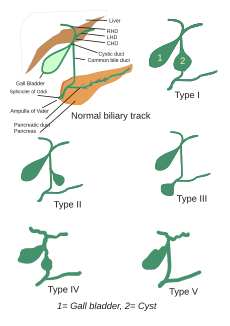 Koledokal cists.svg