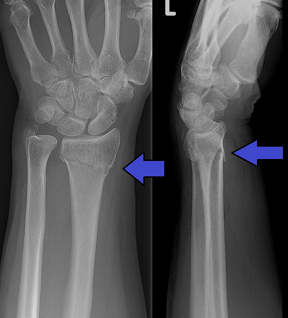 Physio 🩺 on Instagram: A Colles fracture 🖐 is a type of broken wrist  (fracture). It is also known as 'Dinner fork deformity '.It's also called a  distal fracture with dorsal angulation (