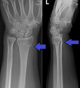 Collesfracture.jpg