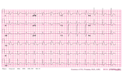 Thumbnail for File:De-Brugada syndrome type1 example5 (CardioNetworks ECGpedia).png