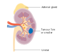 Diagram showing stage 1 kidney cancer CRUK 192.svg