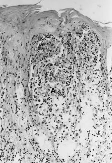 Akantolýza u slintavky a kulhavky ve vzorku váčku z kůže. Lze si povšimnout, nekrózy vrstvy Stratum spinosum a keratinocyty plovoucí v tekutině váčku (spongiosa).