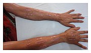 Thumbnail for Dermatitis artefacta