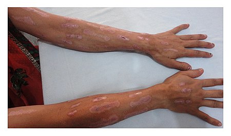 Multiple, well-demarcated, linear, longitudinal erosions on the dorsum of the bilateral forearms