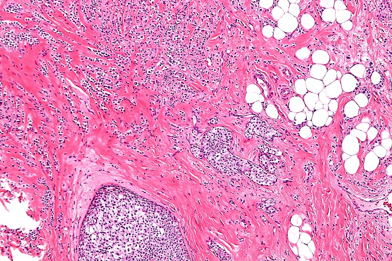 File:Lobular carcinoma - intermed mag.jpg