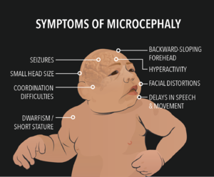 symptoms of microcephaly