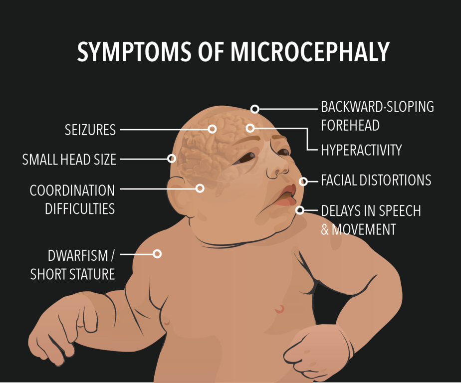 Symptoms of Microcephaly