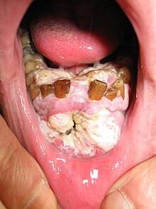 What is mouth cancer?