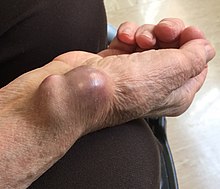 Radial artery pseudoaneurysm. Radial artery pseudaneurysm 20180607b.jpg