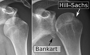 X-ray at left shows anterior dislocation in a young man after trying to get up from his bed. X-ray at right shows same shoulder after reduction and internal rotation, revealing both a Bankart lesion and a Hill-Sachs lesion.