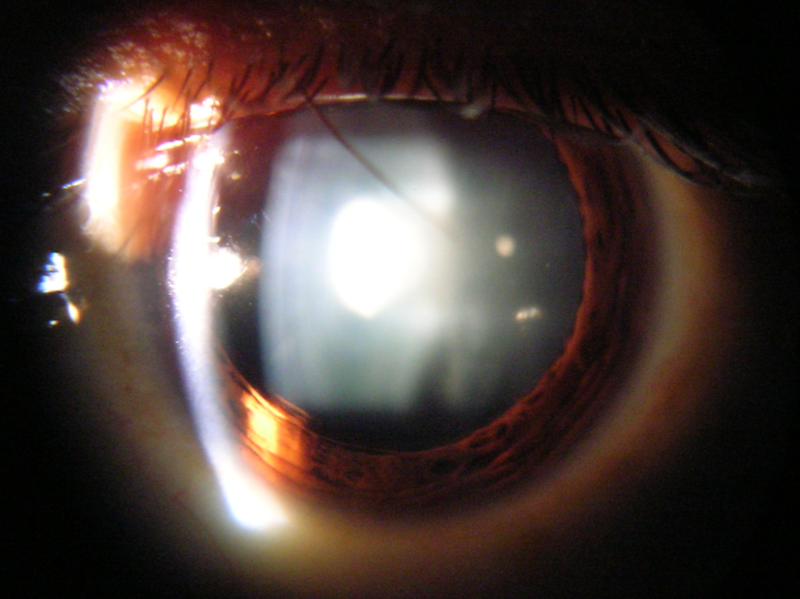 File:Slit lamp view of Cataract in Human Eye.png