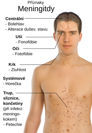 File:Symptoms of Meningitis cs.svg