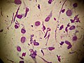 Tadpole cells on a smear taken from a patient with allergic contact dermatitis.jpg